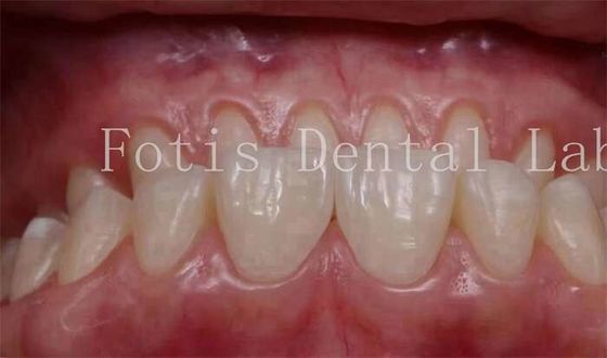 Good price Customized Natural Looking Snap On Veneers 0.3mm-0.5mm Thickness online