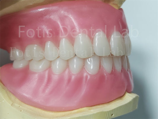 Good price Ivoclar Teeth Full Acrylic Denture Prosthesis Easy To Clean High Durability online