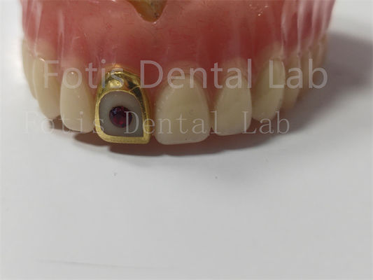 Good price Comfortable Full Acrylic Denture For Professionals Stain / Odor Resistant online