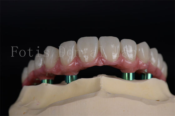 Long Lasting All On 4 All On 6 Implants Natural Looking Aesthetics No Age Limit Recovery