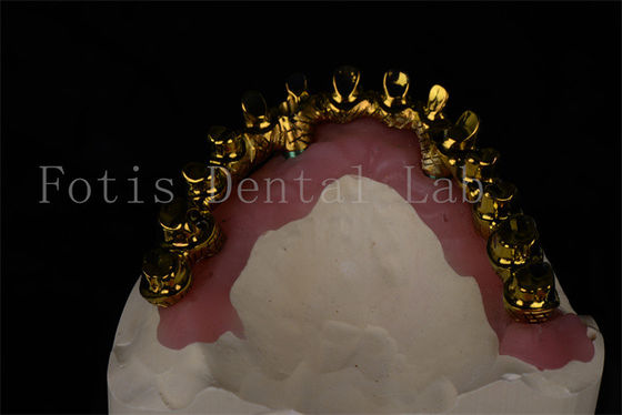 Good price Natural Looking All On 4 All On 6 Dental Implants Restores Full Chewing Ability online
