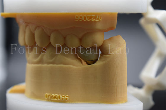Good price Long Lasting Polished Dental Lab Crowns Precision Fit Comfort For Patients online