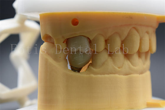 Good price Customizable Dental Implant Abutment Crown Comfortable For Patients online