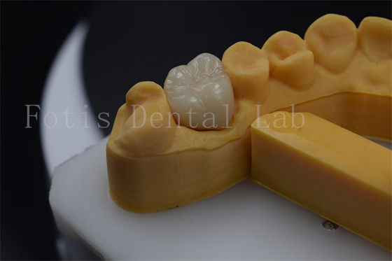Good price Titanium / PFM Denture Crown Customizable Zirconia Implant Crown Durable online