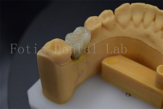 Good price Long Lasting Comfortable  Dental Implant Crowns For Restoration Of Missing Teeth online