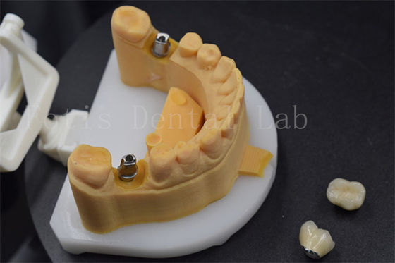 Good price Easy To Place Zirconia Teeth Crown Titanium Crowns For Teeth Customised online