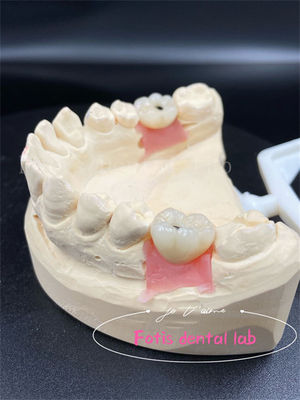 Good price Customization Titanium/Ziconia/PFM Dental Lab Crowns Comfortable online