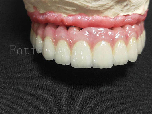 Good price Titanium / Zirconia Implant Crown Polished Finish Artificial Dental Crown online