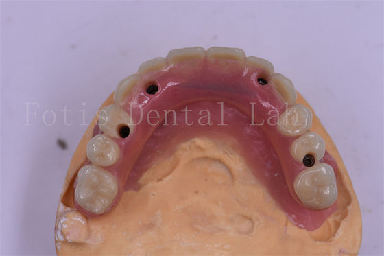 Good price Dental Implant Titanium Tooth Crown Precision Fit Custom Design online
