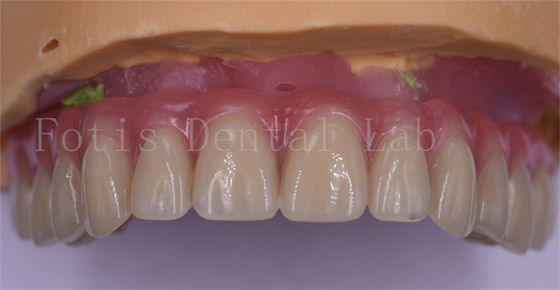 Good price Patient Comfort Custom Dental Crowns Polished Titanium/Zirconia/PFM Implant Crown online