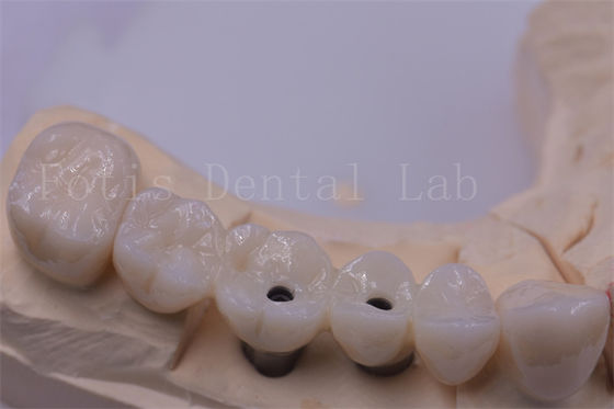 Good price Titanium / Zirconia Dental Crown Silver Polished For Missing Teeth online