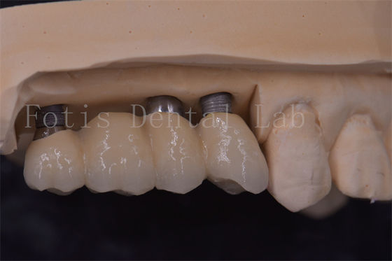 Good price Precision Fit Dental Implant Crowns Titanium / Zirconia / PFM Restoring Missing Teeth online