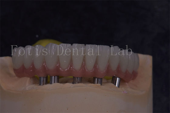 Good price Customizable Dental Implant Crowns For Natural Looking And Comfortable Restorations online
