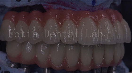 Good price OEM Service Durable Dental Implant Temporary Crown Easy Maintenance online