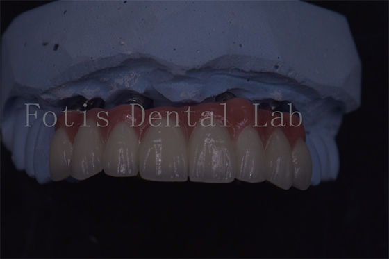Good price Precision Crafted Dental Implant Crowns For Superior Longevity And Comfort online
