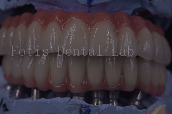 Good price Advanced Clinic Dental Implant Crowns For Superior Functionality online