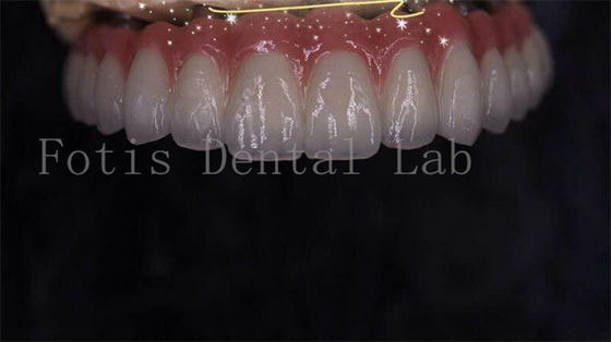 Good price Modern Seamless Integration Implant Retained Crown Easy To Clean online