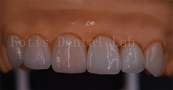 Good price 3 Shape Digital Crowns Good Compatibility Dentrues Design 1 Day Delivery online