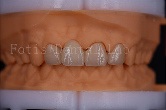 Good price FDA Certified Digital Crowns Bridge Dentrues Design  Customizable Size online