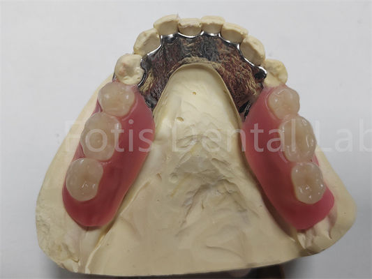 Good price OEM Flexible Removable Partial Denture  Easy To Clean / Maintain online
