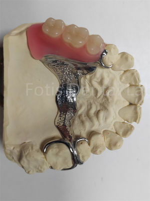 Good price Durable Odor Resistant Removable Partial Denture Highly Adjustable online
