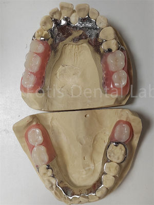 Good price Customization Temporary Partial Dentures Compatible With Natural Teeth online