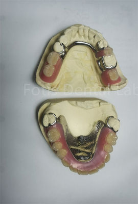 Good price PEEK Upper Removable Partial Denture Requires Regular Maintenance online