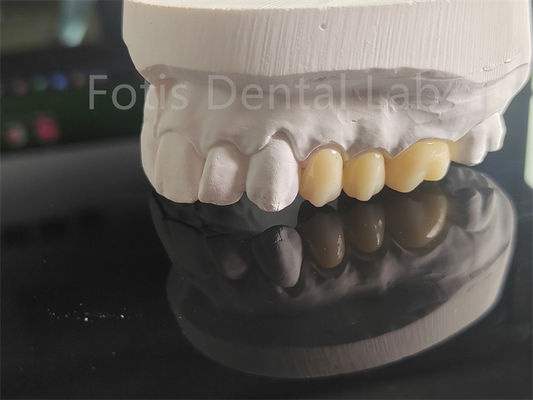 Good price High Strength  Full Porcelain Layered Zirconia For Dental Crowns online