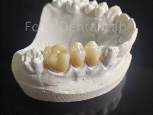 Good price Wear Resistance Zirconia Layered With Porcelain Dental Material online