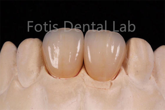 Good price High Translucency Multi Layer Zirconia For Fabrication Of Dental Restorations online