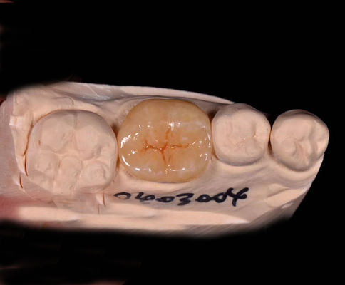 Good price Custom Made Indirect And Porcelain Inlays And Onlays With Dental Overlays online