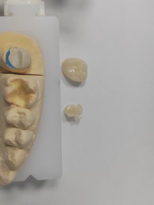 Good price Long Lasting Restorations Dental Inlay Onlay Superior Strength And Durability online