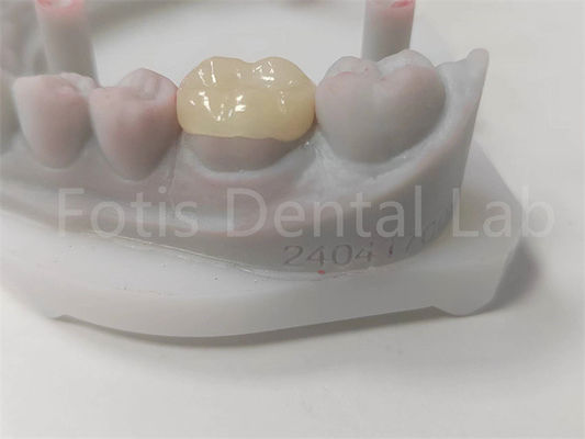 Good price OEM Dental Inlay And Onlay Ceramic Restoration And Tooth-Colored Filling online