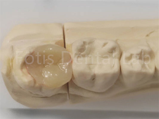 Good price Aesthetic Inlay And Onlay In Dentistry For Indirect Filling And Tooth Restoration online