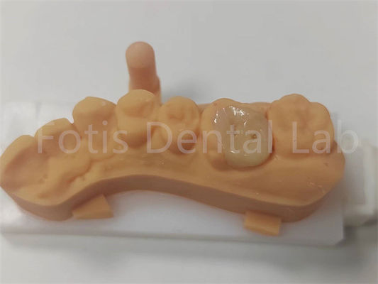 Good price Dental Restorations Ceramic Inlay And Onlay For Long Lasting online