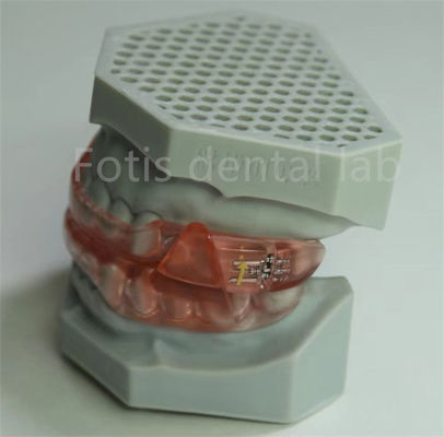 Affordable Dental Lab Hyrax Expander Orthodontic Retainer Easy To Clean And Maintain